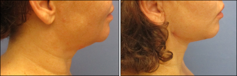 facelift